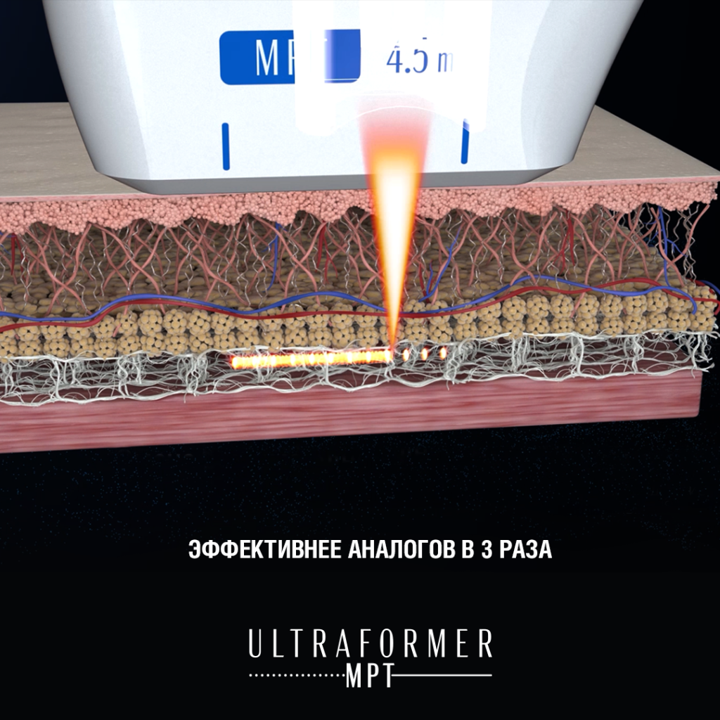 ultraformer mpt_3.png